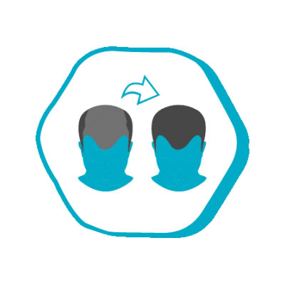 j4 j4 После операции по пересадке волос Istanbul Hair Россия Цены в Турции